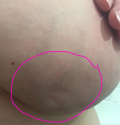 Skin Dimpling sign of breast cancer