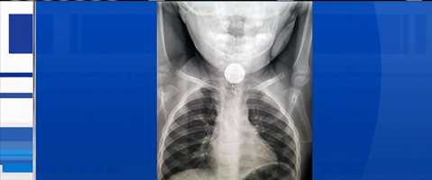 X-ray shows battery stuck in toddler's esophagus