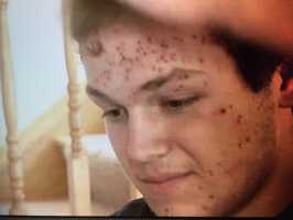 High school wrestler Blake Flovin contracts herpes from wrestling match
